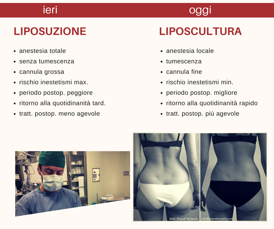 Liposcultura per la rimozione del grasso