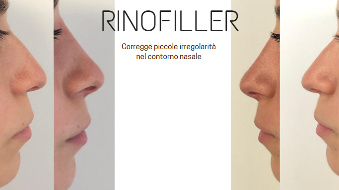 Rinofiller Roma Pascal Scioscia chirurgo plastico Roma EUR Casal Palocco Albano Laziale Roma EUR