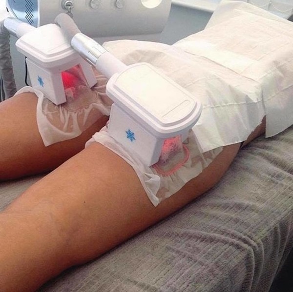 Criolipolisi per ridurre la cellulite Roma EUR Casal Palocco 