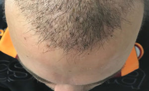Autotrapianto dei capelli tecnica FUE Roma dott. Scioscia chirurgo plastico roma eur, albano laziale, appia , pomezia, casal palocco infernetto
