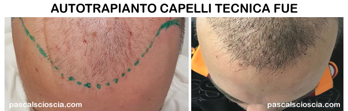 Trapianto dei capelli con tecnica FUE Roma