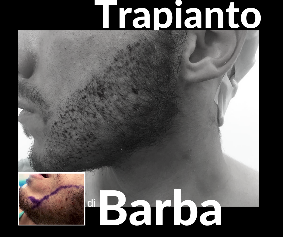 Trapianto di Barba con tecnica FUE Roma